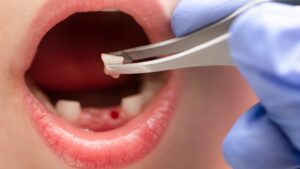 Tooth Extraction With Inflammation – Is It Possible to Remove a Tooth With an Infection?